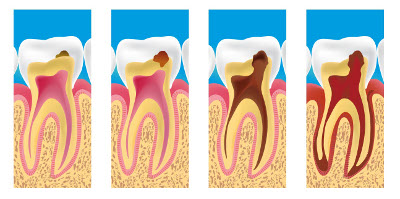 caries dentiste blanc mesnil